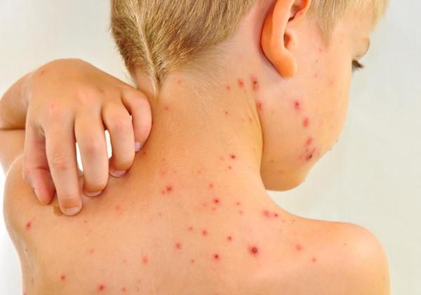 chickenpox vaccination for children reviews
