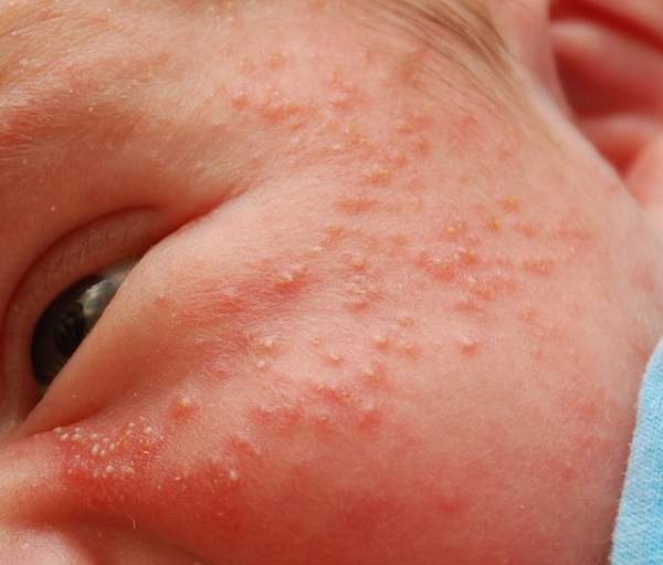Signs of heat rash in a baby