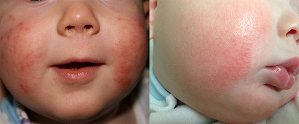 проявление аллергии на щеках