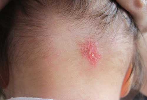 Manifestation of atopic dermatitis in a child