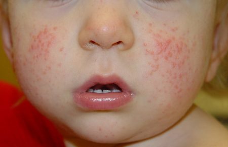 Manifestation of the disease on the child’s cheeks