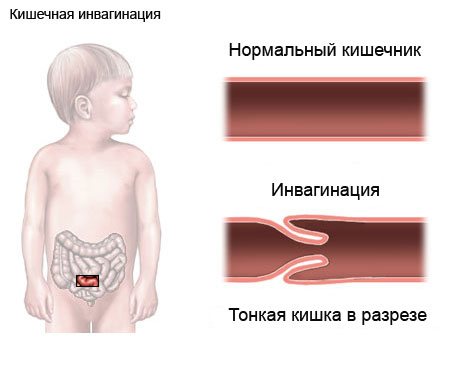 Development of the disease in children