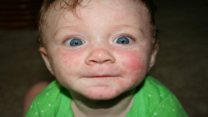 Roseola rosea can cause great discomfort to babies