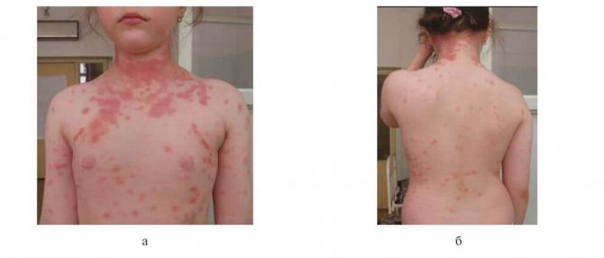 pityriasis rosea on the back, chest and abdomen