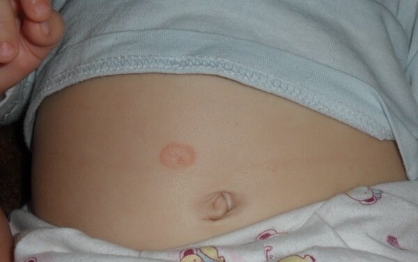 pink lichen on the baby&#39;s stomach