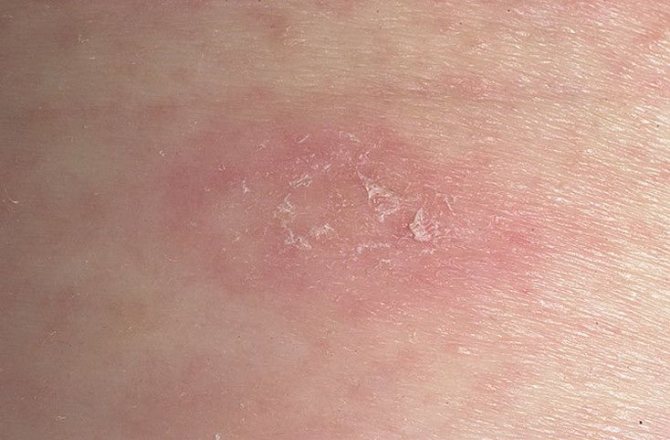 Pityriasis rosea in a child photo signs and treatment Komarovsky