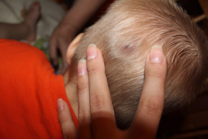 Bumps on the head of children are a common occurrence.