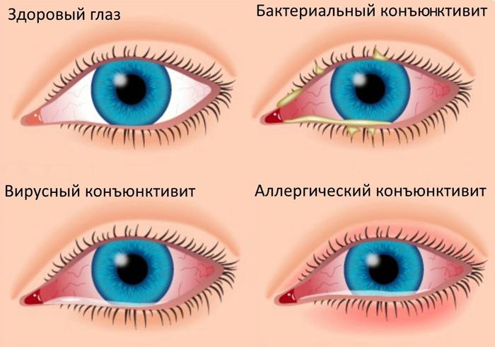 Symptoms and types of conjunctivitis
