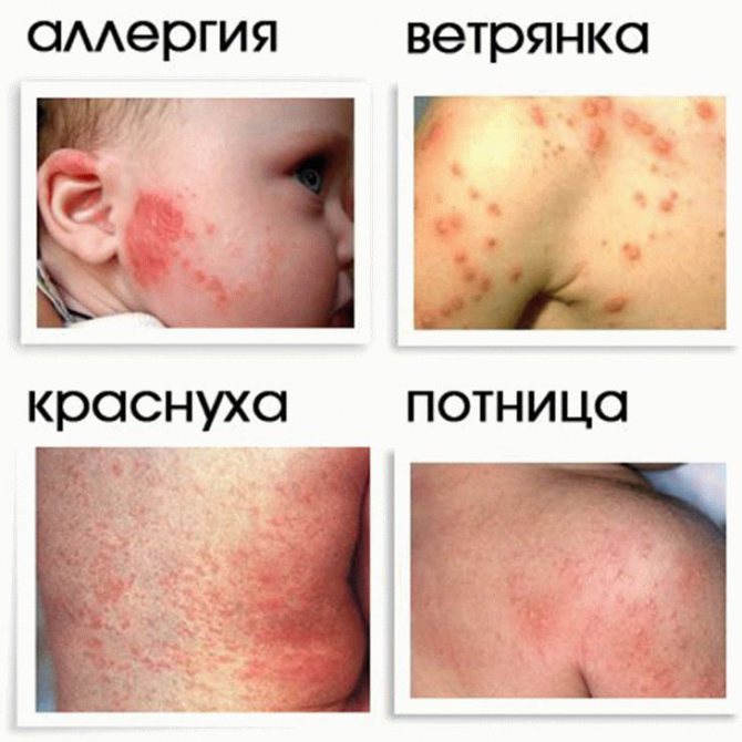 comparison of rashes