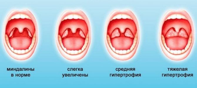 Stages of enlarged tonsils