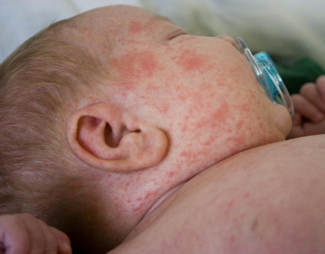 Dry pink spots on baby&#39;s skin