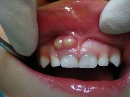 Fistula with sinusitis and healthy teeth