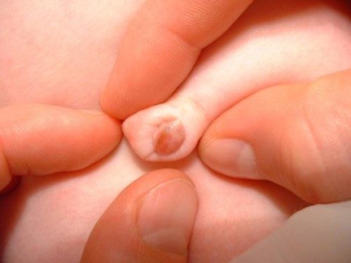 umbilical fistula in children