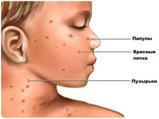 The child has a small rash on the face