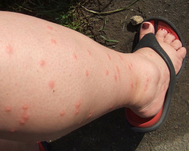 Укус комара: чем лечить?