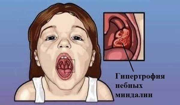 Enlarged tonsils in children