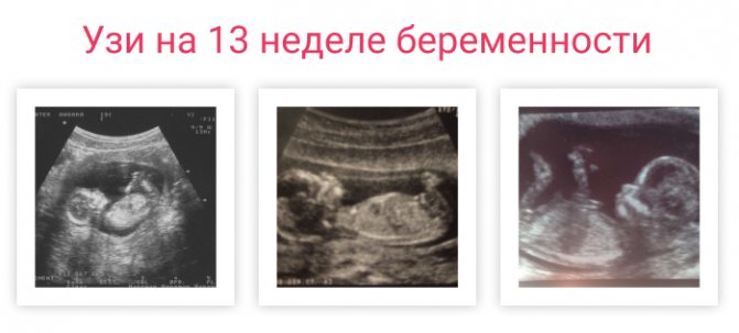ultrasound at 13 weeks of pregnancy