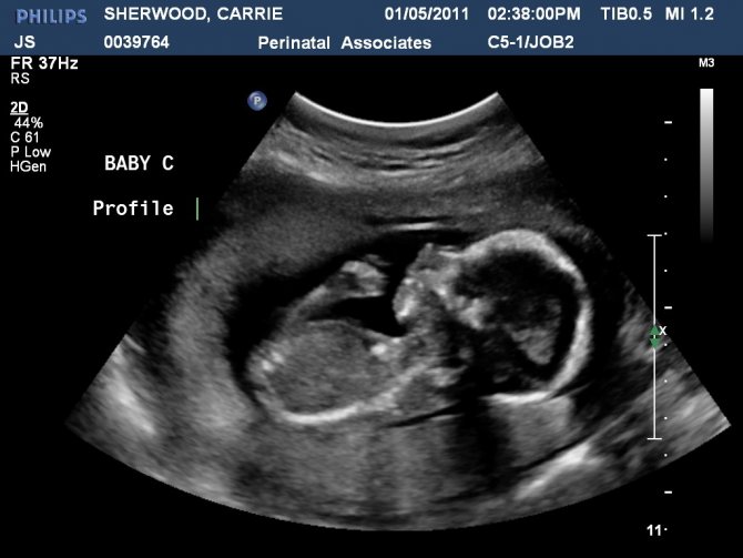 Ultrasound at 17 weeks of pregnancy