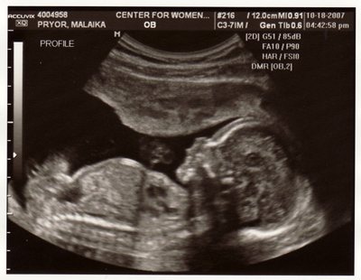 Ultrasound at 32 weeks of pregnancy