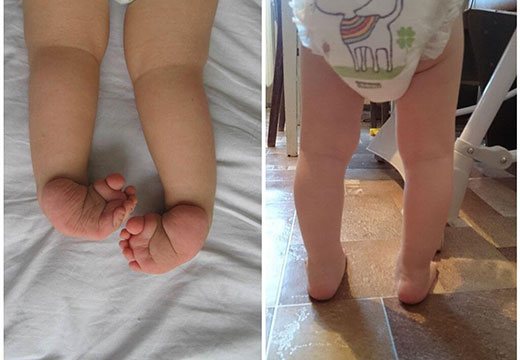 types of childhood clubfoot