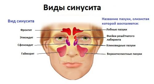 Types of sinusitis