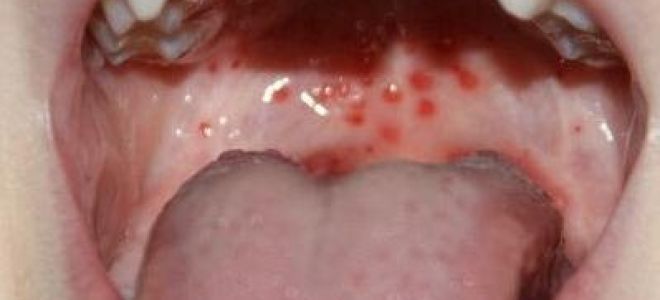 herpes virus in a child&#39;s throat