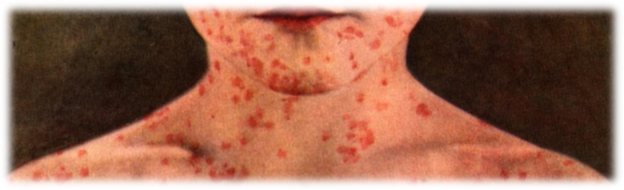 measles viral infection