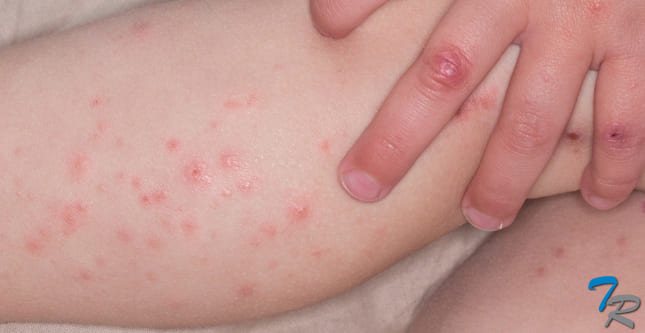 watery blisters on the skin of a child