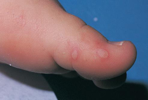 blisters on a child&#39;s feet