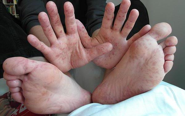 blisters on hands and feet
