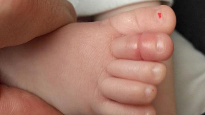 Ingrown toenail in a baby: how to treat it